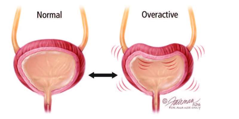 Overactive Bladder (OAB)