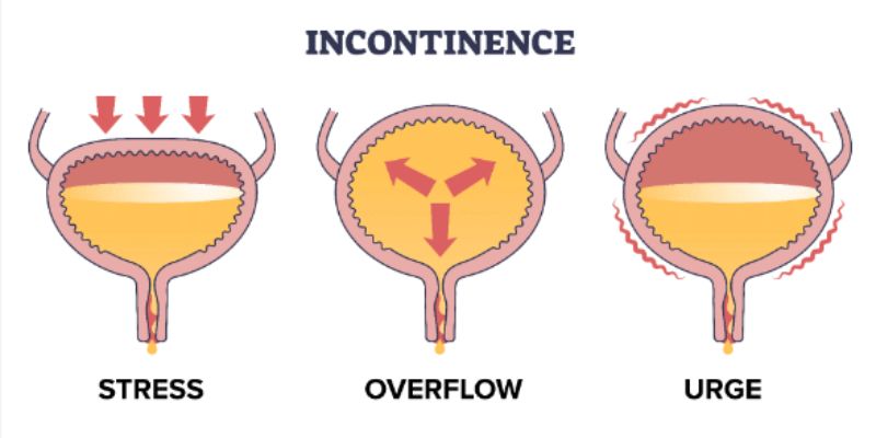 Tips to Manage Frequent Urination