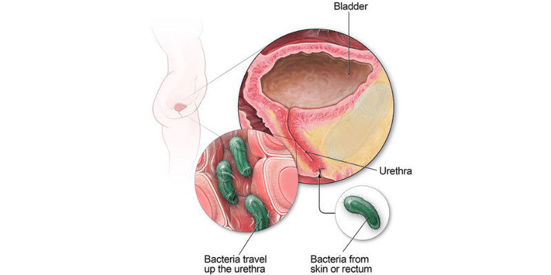 Urinary Tract Infections (UTIs)