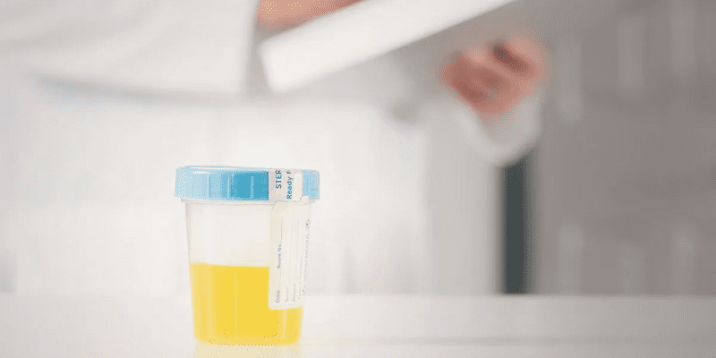 Why Do We Test Creatinine in Urine?