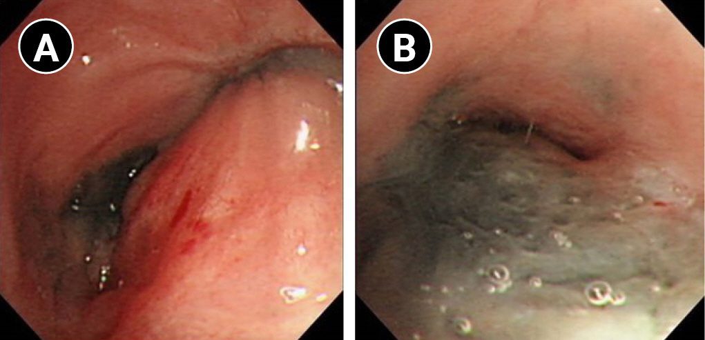 Does Herpes Cause Blood in Urine